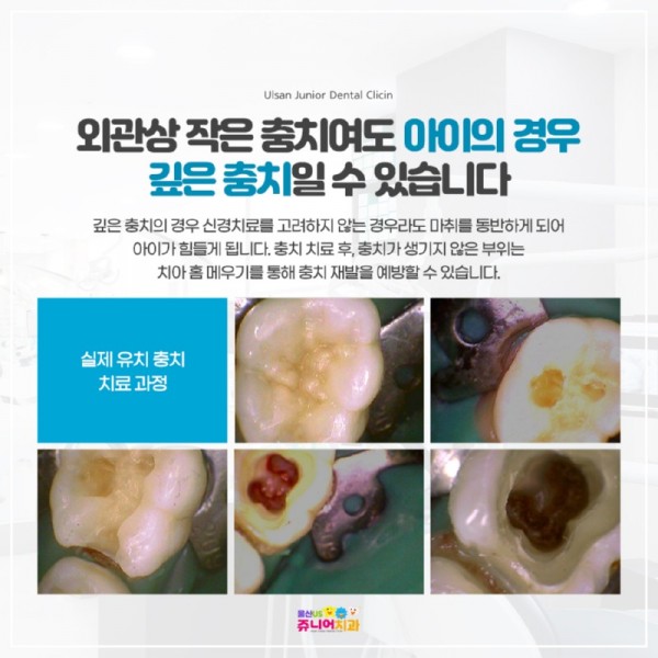 20221128-울산일산지치과-어린이충치치료(6).jpg
