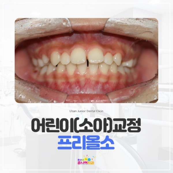 20221202-울산동구소아치과-프리올소치아교정(1).jpg