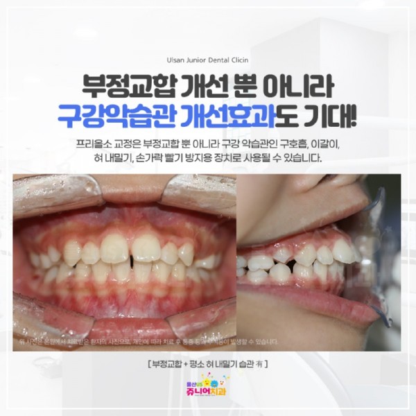 20221202-울산동구소아치과-프리올소치아교정(4).jpg